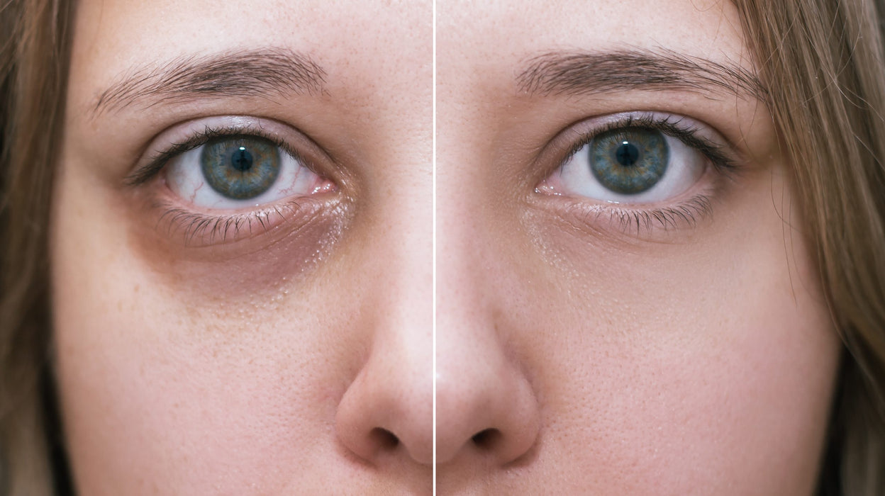 Under eye fillers