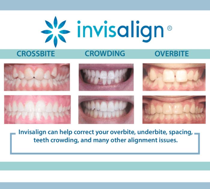 Invisalign